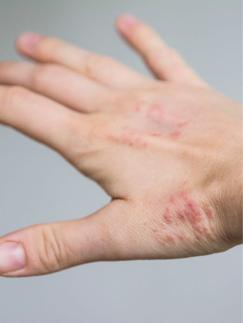 Strawberry Rashes Strawberry Allergy: Symptoms, Testing and Alternative foods – Check My ...